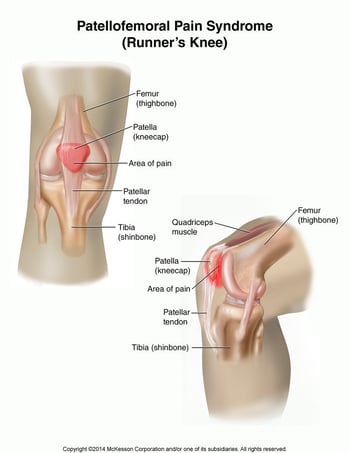 image-result-for-patellofemoral-pain-syndrome
